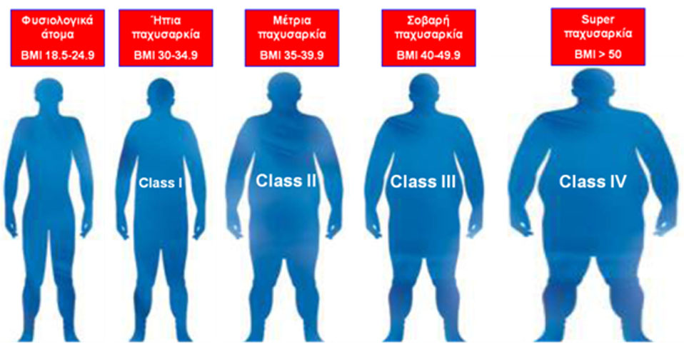 Read more about the article Παχυσαρκία – μια ΧΡΟΝΙΑ «Υποτροπιάζουσα» ΝΟΣΟΣ